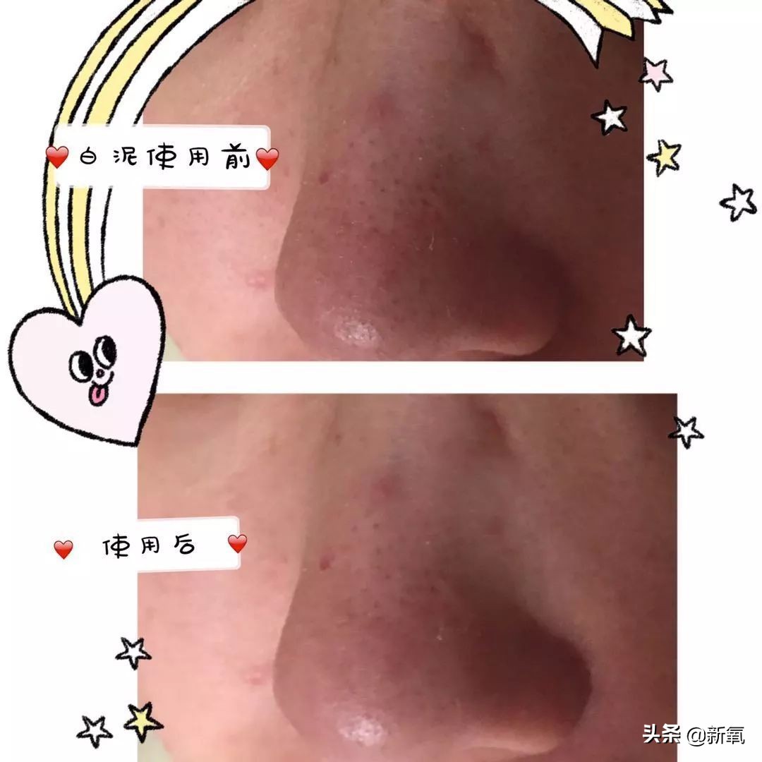 目前有真正去黑头的方法,最近超火的去黑头