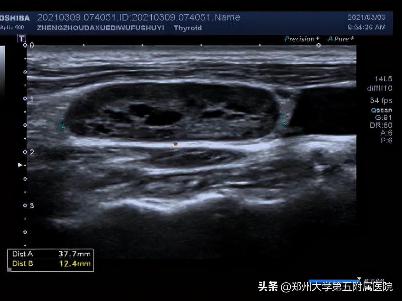 小小淋巴细胞,淋巴结有很多小小的会影响生命吗