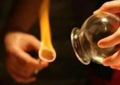 咳嗽拔罐啥穴位,咳嗽止咳最佳拔罐疗法