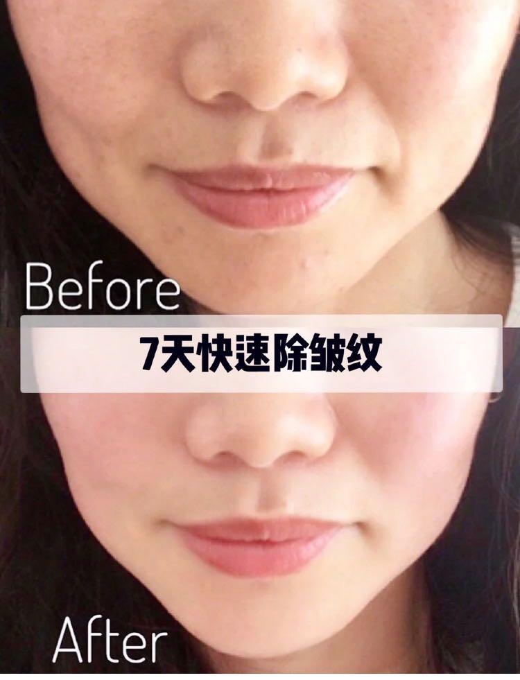 为了变美到底该不该打玻尿酸,玻尿酸注射后变丑了怎么办