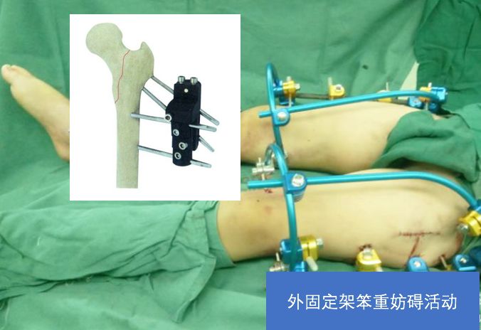 老年髋部骨折最常见的部位,髋部骨折危害大老年人摔伤要重视