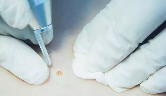 到底要不要祛痣,该不该去医院点痣