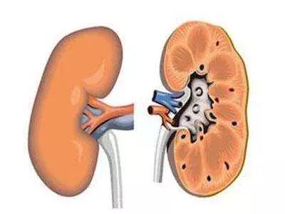双肾多发结石取出2000多颗,史上最大手术取出肾结石