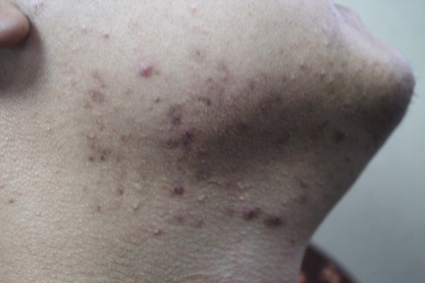 女人熬夜上火脸上起痘痘怎么回事,熬夜脸上长痘痘有闭口用什么药