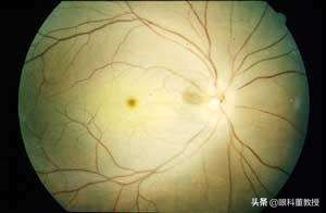 老人眼底视力模糊怎么办,老人视网膜脱落怎么恢复视力
