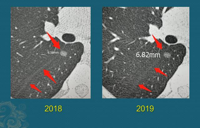 磨玻璃结节术后又长出2mm小结节,磨玻璃结节2mm基本上是癌