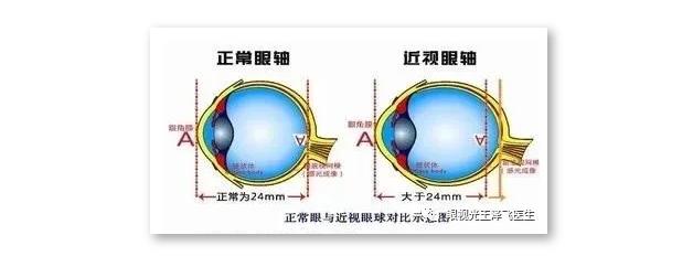 眼镜戴久了眼睛会变形变凸吗,经常戴近视眼镜眼睛会凸吗