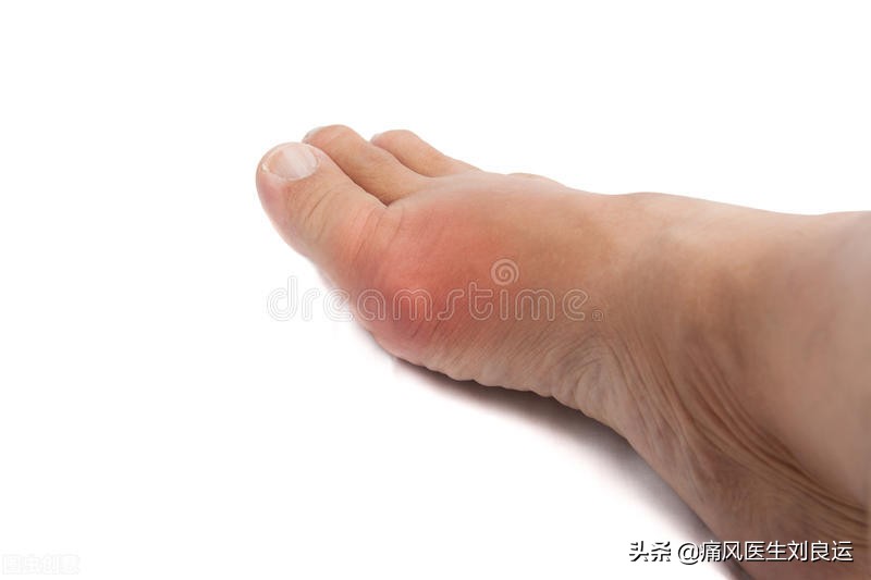 痛风发作大脚趾不能活动,痛风发作时只痛不肿不热为什么