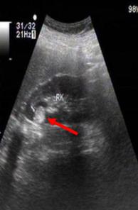 肾上长错构瘤怎么办,肾错构瘤是什么意思