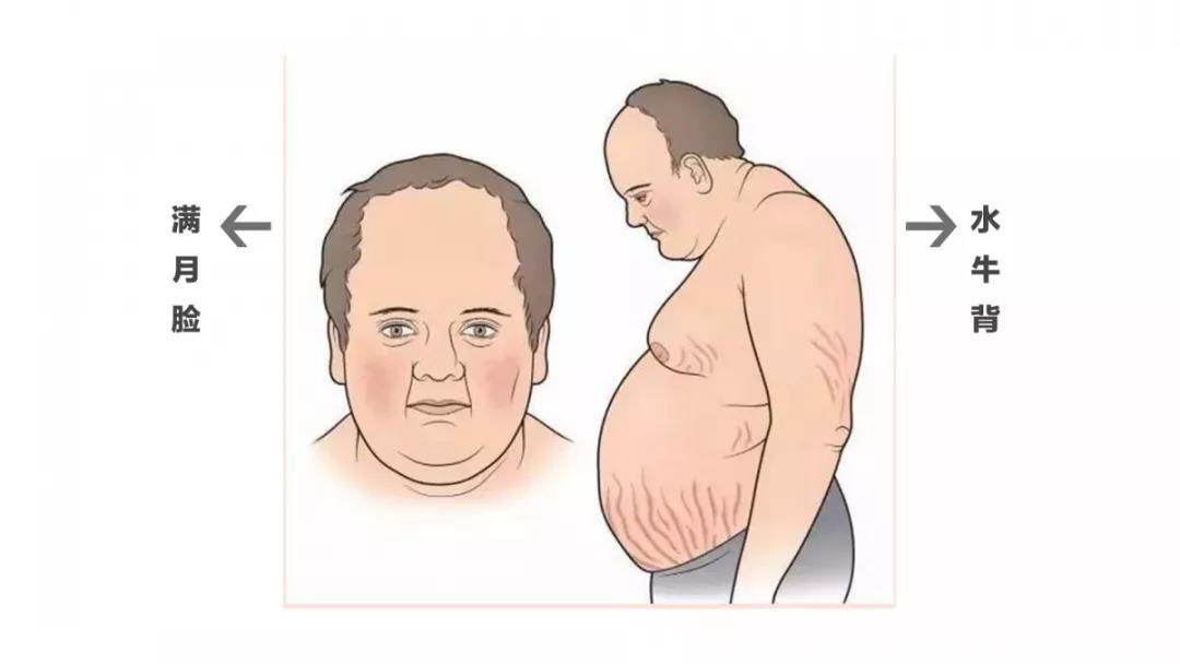 风湿病患者谈“激素”色变！正确认识糖皮质激素，助你早日康复