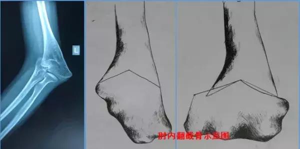 人的胳膊肘都是往里拐的,胳膊肘往里拐是什么原因