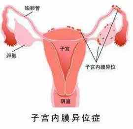 痛经导致不孕的几率,痛经前两天特别疼会不孕吗