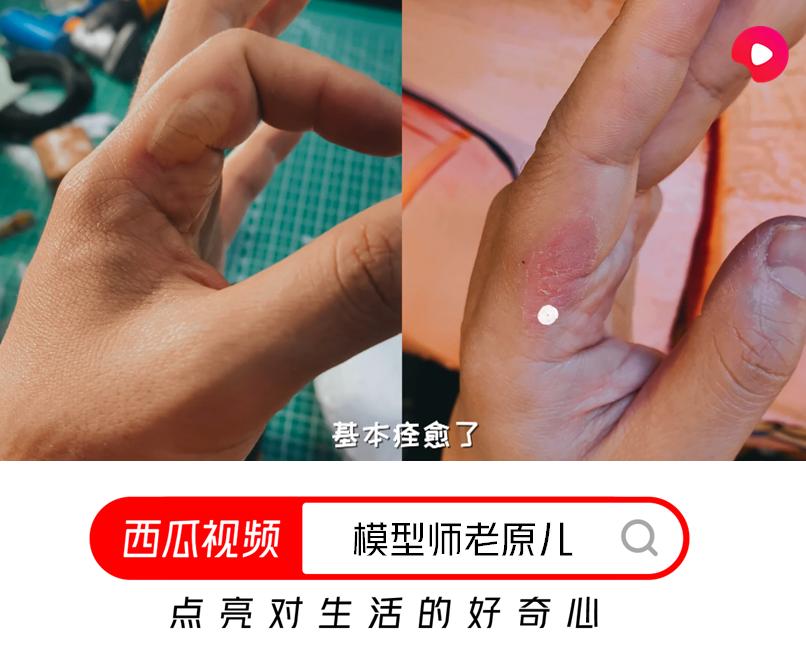 深二度烫伤和浅二度烫伤对比图片,烫伤的泡变暗红色