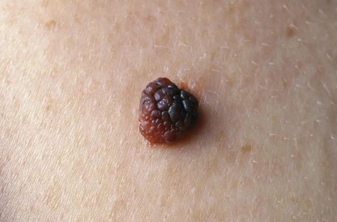 脸上点了痣能洗脸吗应注意什么,这四种痣一定要引起注意了