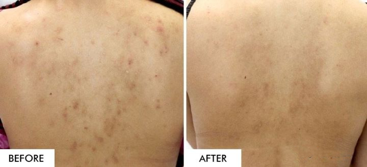 夏天来了祛痘痘,夏天来了长痘痘了怎么办