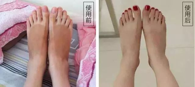 手脚干裂皮肤又厚又痒怎么办,冬天手脚干裂起皮怎么治疗