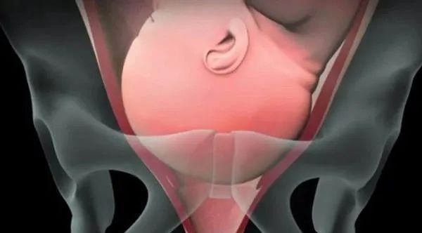 分娩直接剖还是顺转剖好,水下分娩会顺转剖吗