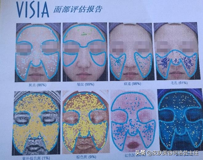visia皮肤检测是什么原理,visia皮肤检测值多少是正常的
