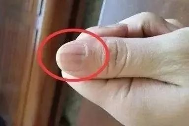 指甲上长斑点是身体发出求救信号,指甲上有皱纹有什么信号求救