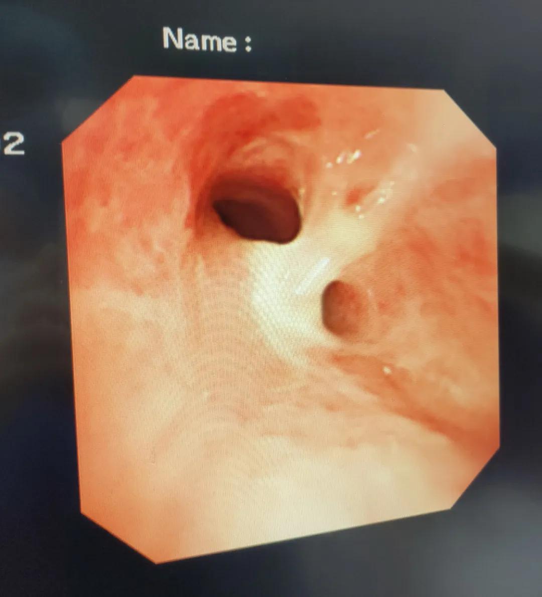 鱼刺卡住吞饭更严重示意图,鱼刺卡喉吃馒头咽下去了会怎样