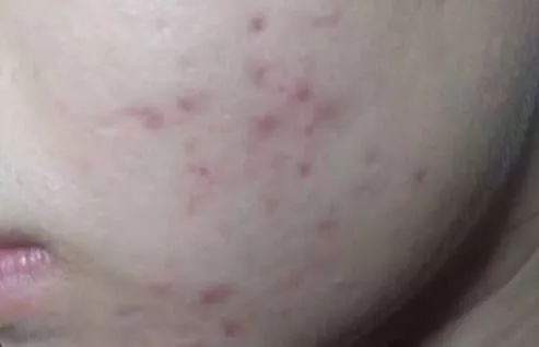 如何有效祛除痘印简单方法,怎么有效简单的祛除痘印的方法