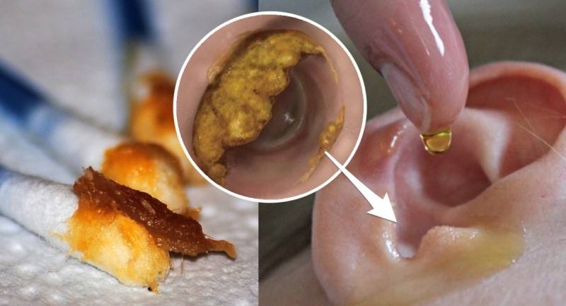 掏耳屎去哪里可以掏得干净,掏耳屎要到专门的医院去吗