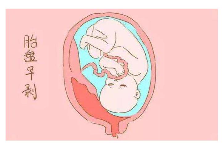 孕妇肚子疼了3小时才上医院,检查发现没了胎心