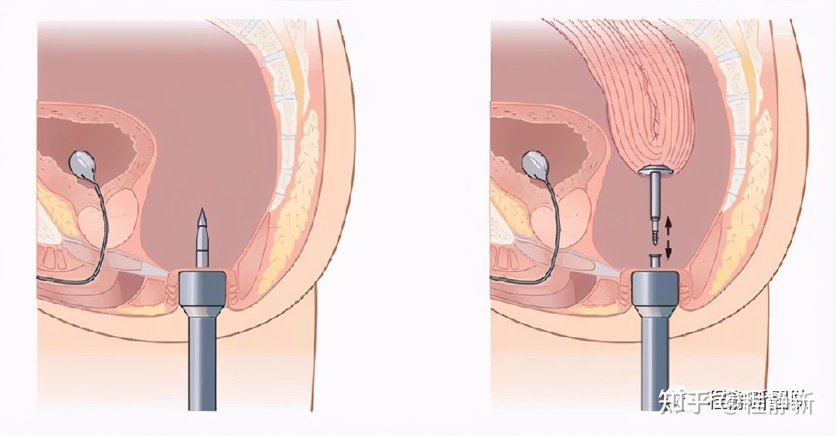妇科手术告别瘢痕，腹腔镜手术圆您爱美的梦