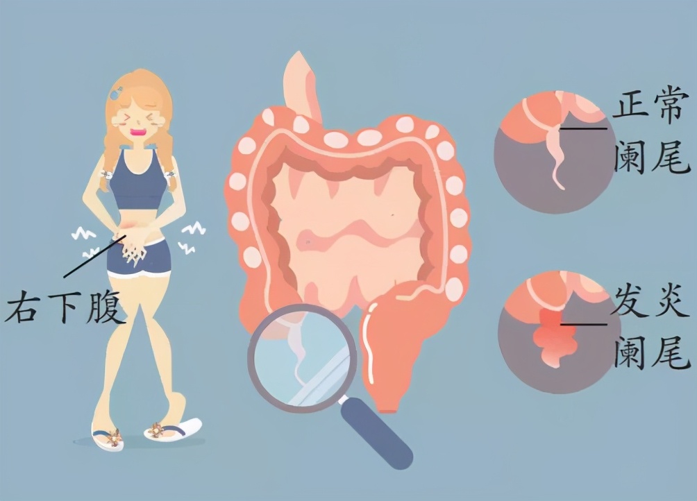 阑尾炎一定要开刀吗?听说不开刀能保住阑尾,靠谱吗?