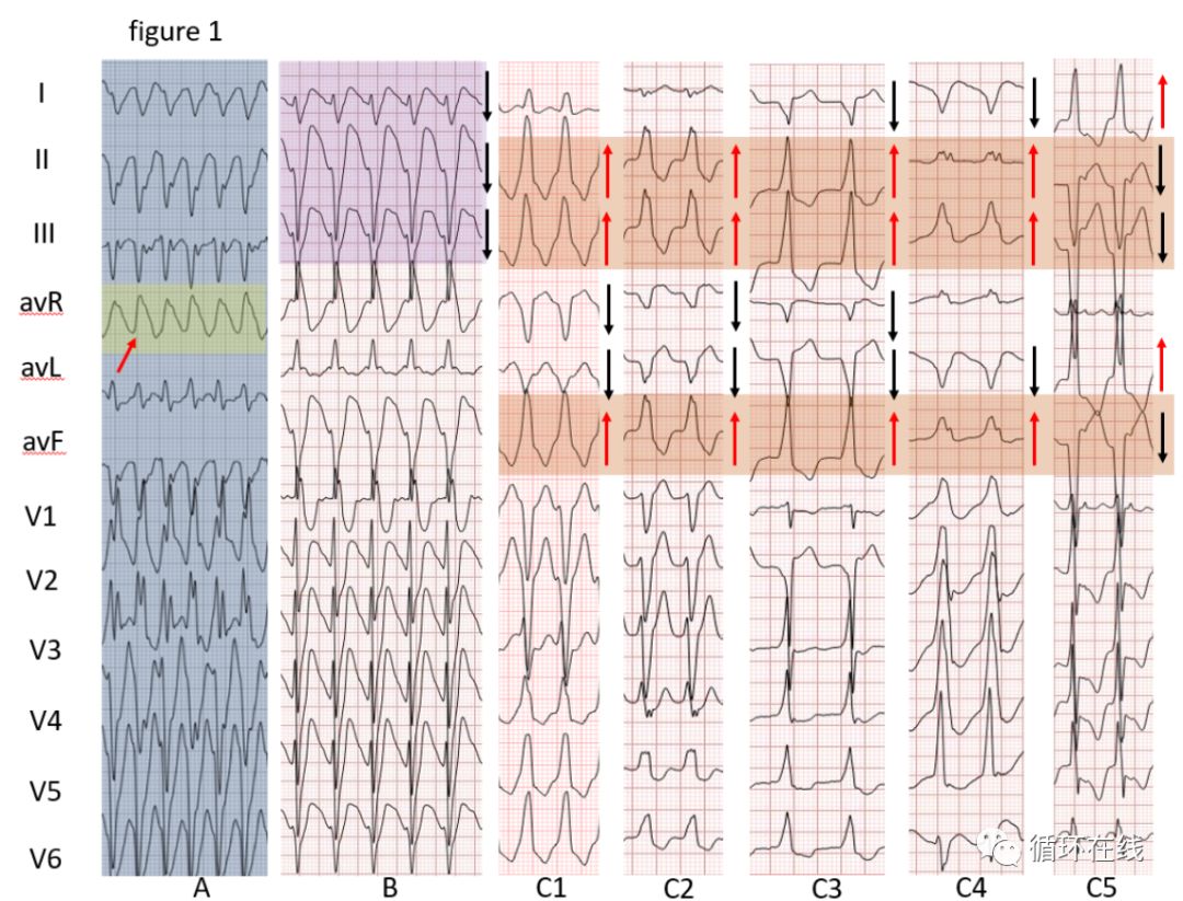 「彤心飞传」宽QRS波心动过速诊断新方法—肢体导联诊断法（LLA）