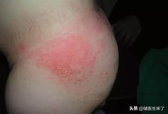 治疗儿童皮肤病的外用药,儿童皮肤病有哪些偏方