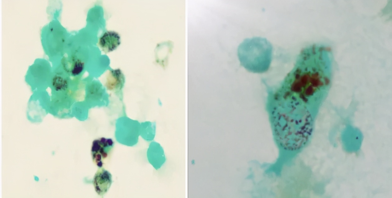 间质性肺病治疗后会加重吗,化疗后肺部间质性的病变