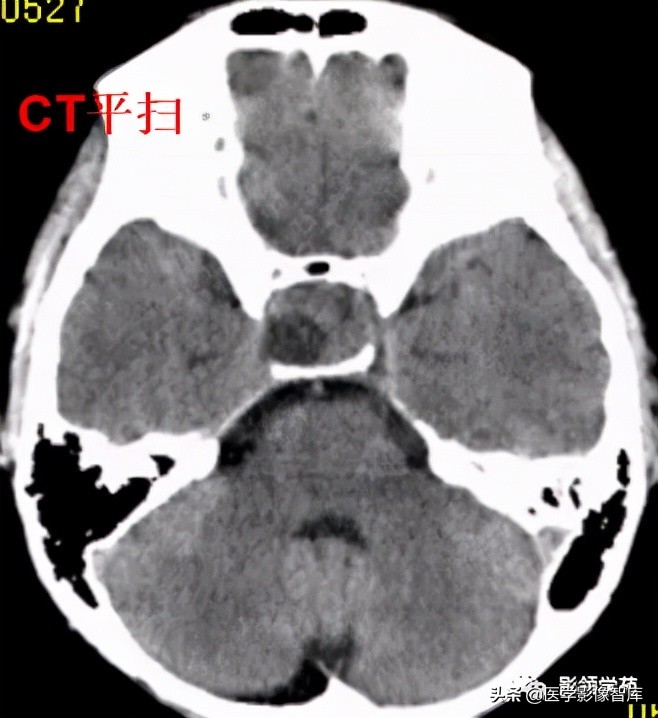 鞍区肿瘤做什么检查得出来,鞍区肿瘤的影像学鉴别
