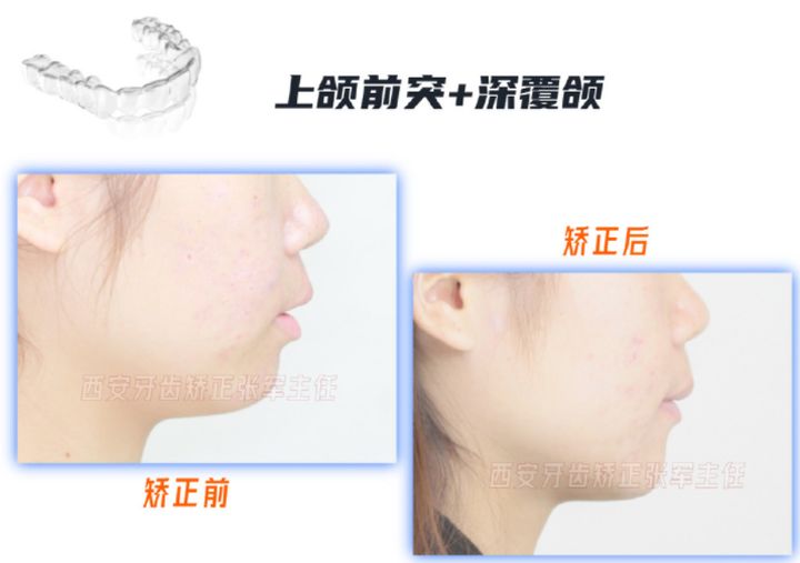 牙齿矫正雁塔区,矫正牙齿拔掉4颗智齿