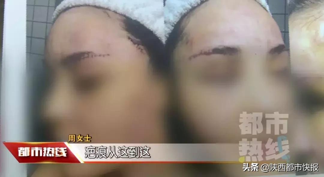 女子打童颜针修复,一女子打瘦脸针毁容