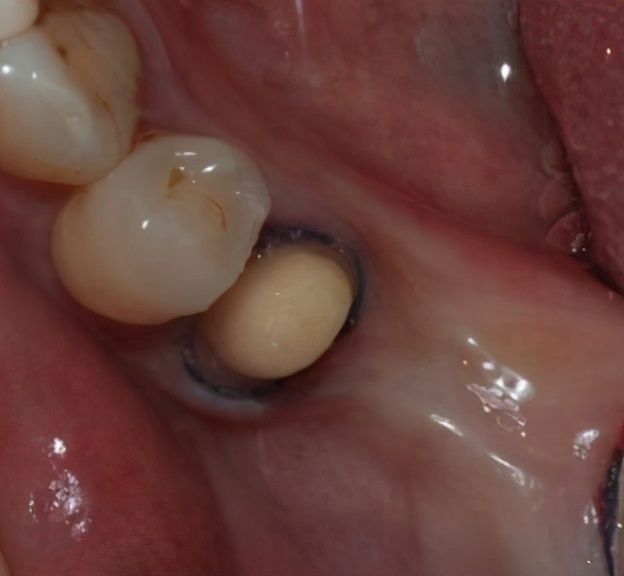 带牙冠里的牙齿烂掉了怎么办,戴的牙冠掉了发现牙根发黑