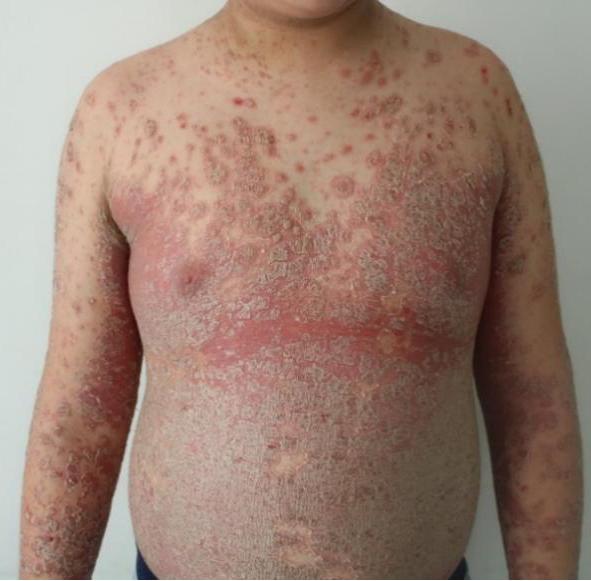 女儿得了银屑病怎么办,宝宝湿疹和银屑病区别