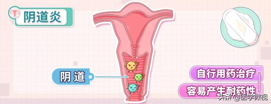 正常的白带有点黄是怎么回事,正常的白带是什么样的呢