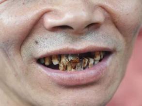 长期吃槟榔会导致什么样的后果,长期吃槟榔对人有什么坏处