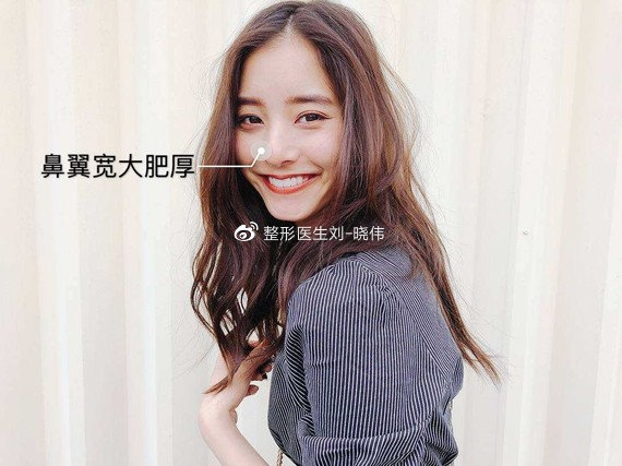鼻翼肥大适合打鼻翼钉吗,鼻翼大怎么缩小且不留痕迹