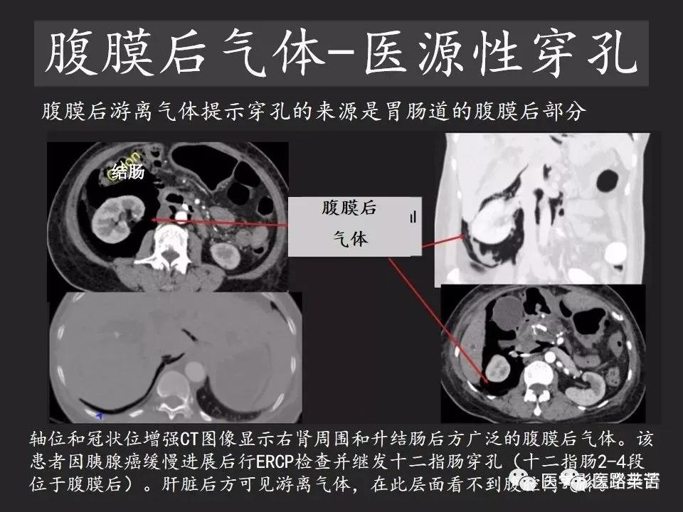 空腔脏器穿孔和胃肠道穿孔区别,腹膜后穿孔一般是哪里穿孔