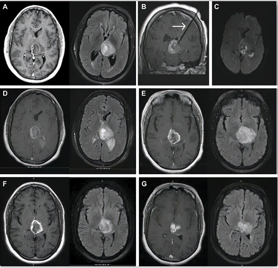 得了脑瘤应该用什么药物治疗最好,良性脑瘤最好的治疗方法是