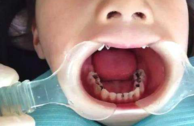 宝宝牙齿有黑色素沉着,宝宝牙齿有像烟渍一样的东西