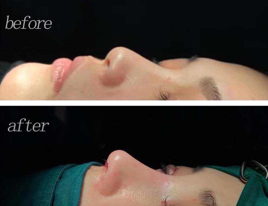 隆鼻对皮肤有什么影响,隆鼻对颜值有多大影响