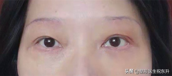 提眉术的优点及缺点,提眉术怎么才算做得好