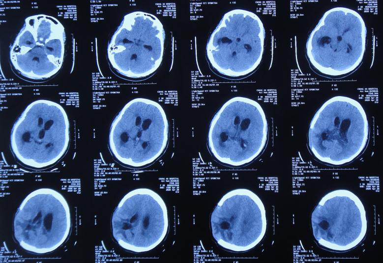 脑室有粘连脑积水有什么办法,脑动脉畸形手术后出现急性脑积水