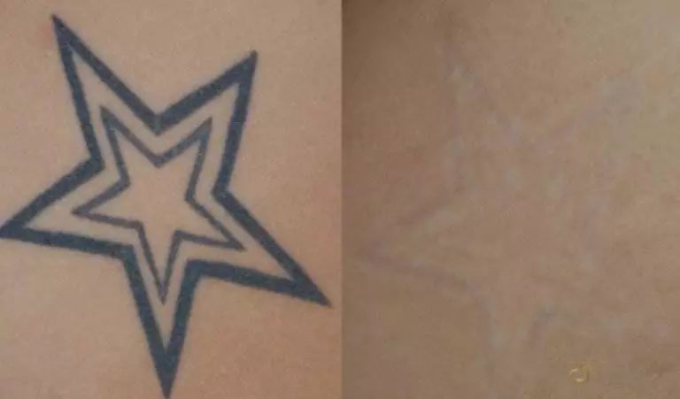 洗纹身健康科普,清洗纹身后需要注意什么