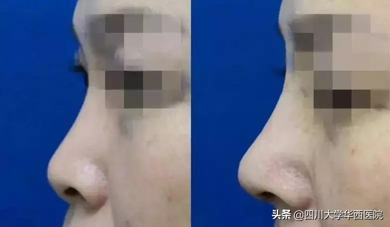 鼻子太翘怎么整形,鼻子太尖整形修复最佳方法