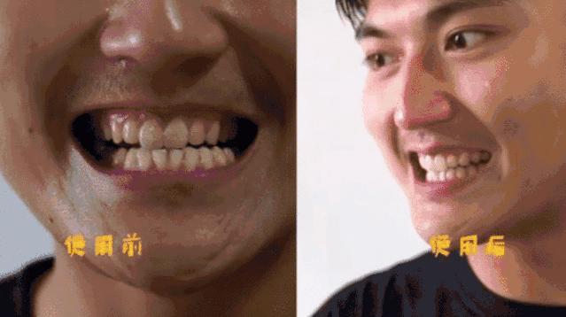 牙黄口臭一招搞定,美白牙齿最有效的方法洗牙