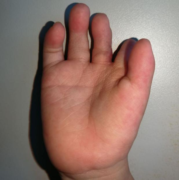 并指畸形免植皮案例,并指畸形